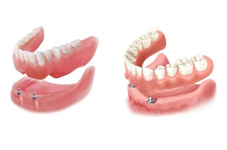 خداحافظی با لقی دندان مصنوعی خداحافظی با لقی دندان مصنوعی